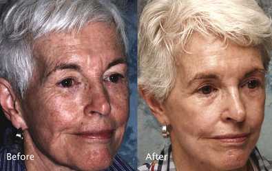 How can you reduce wrinkles with Retin A and get before and after results?